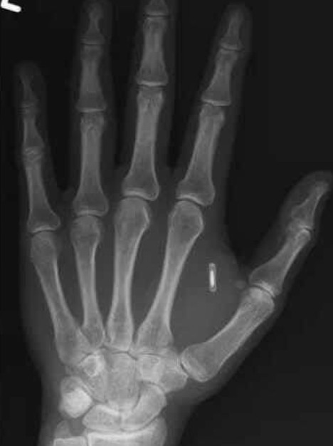 Deri Altına Yerleştirdiği RFID Çipin Şifresini Unutan Amerikalı Gösteri Sanatçısı Zor Anlar Yaşadı